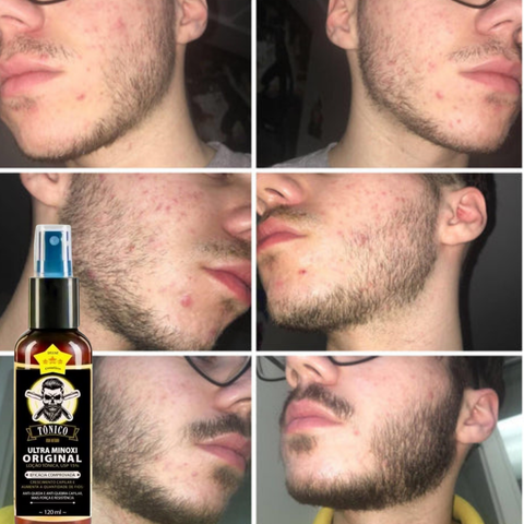 Minoxidil 15% D'Lust Turbo 120ml, para Cabelo, Barba e Sobrancelha